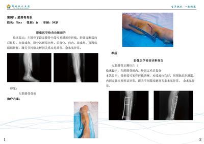 左胫腓骨骨折